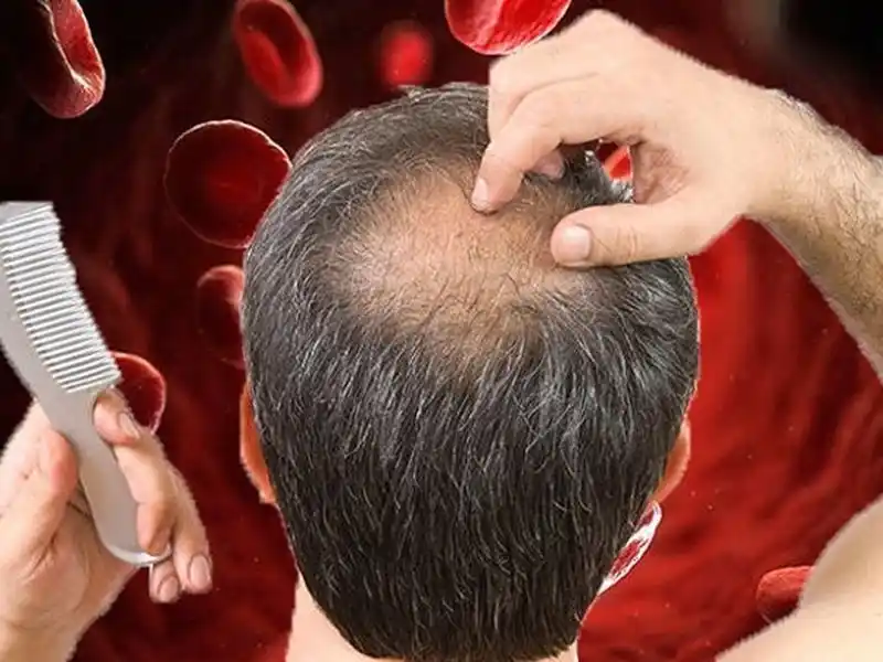 کمبود آهن در بدن و ریزش مو