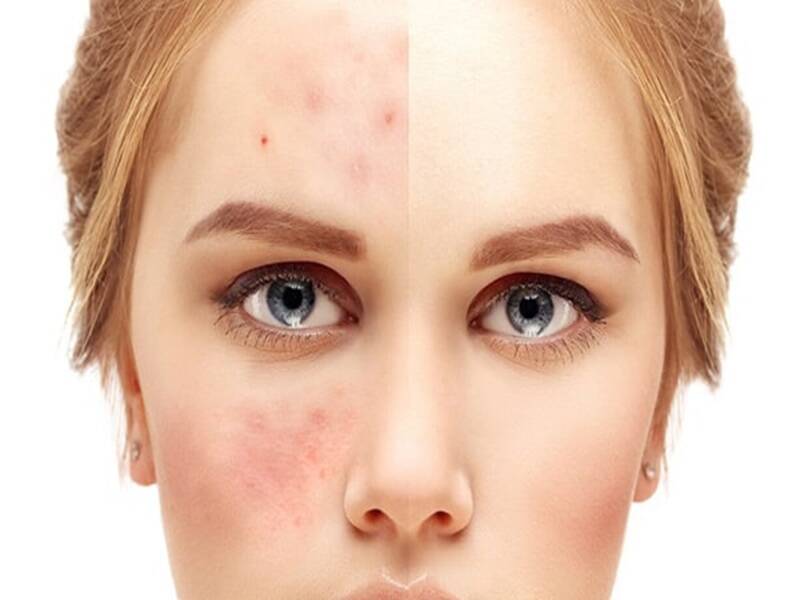 نکاتی برای پیشگیری از جوشهای ناشی از کمبود ویتامین