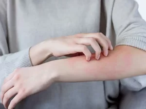 کمبود ویتامین و خارش پوست