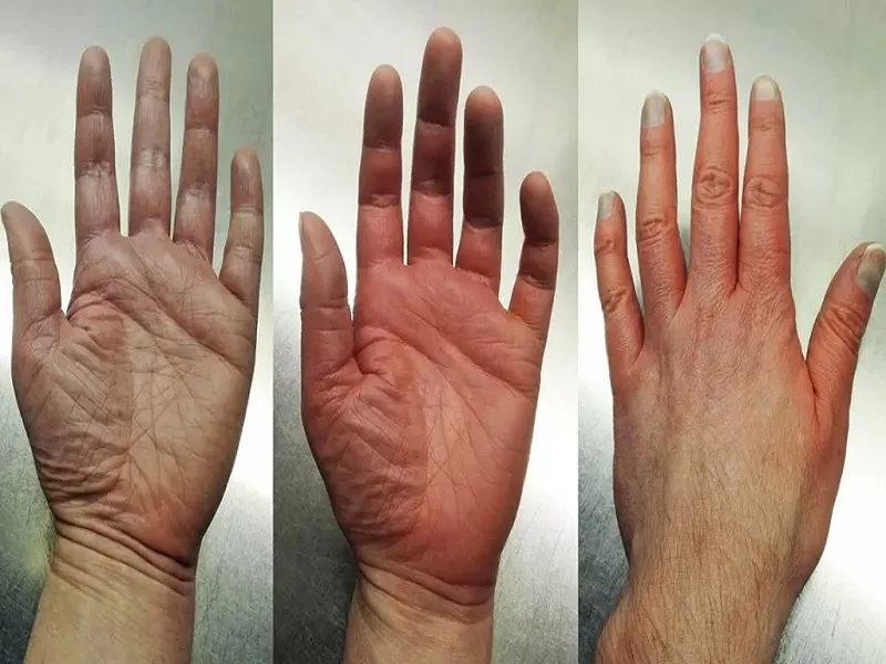عوارض غلظت خون در افراد دیابتی