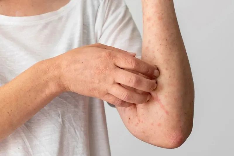 Symptoms of polycythemia