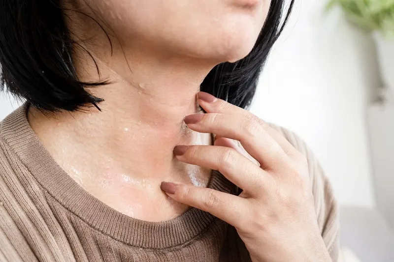 Triggers for itchy skin caused by polycythemia
